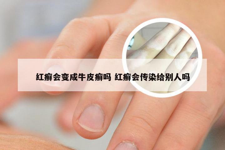 红癣会变成牛皮癣吗 红癣会传染给别人吗