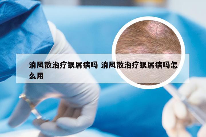 消风散治疗银屑病吗 消风散治疗银屑病吗怎么用