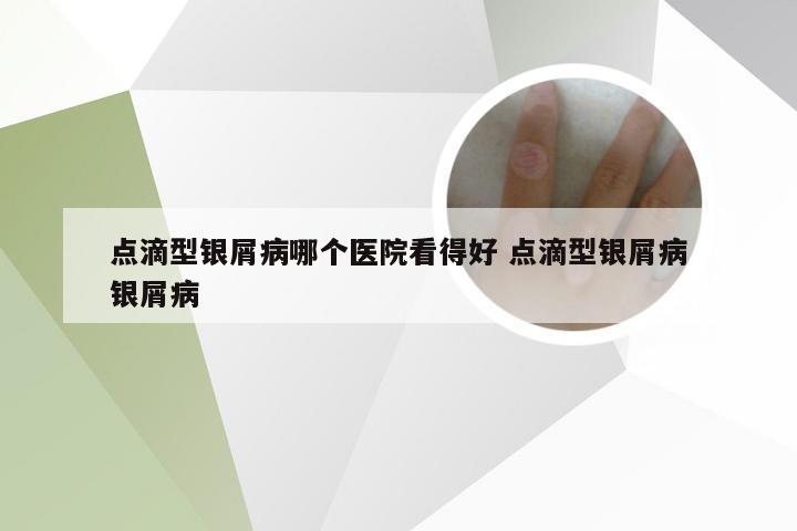 点滴型银屑病哪个医院看得好 点滴型银屑病银屑病
