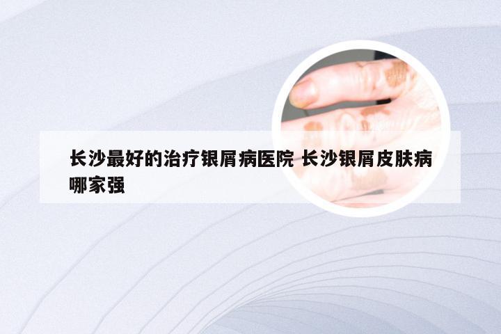 长沙最好的治疗银屑病医院 长沙银屑皮肤病哪家强