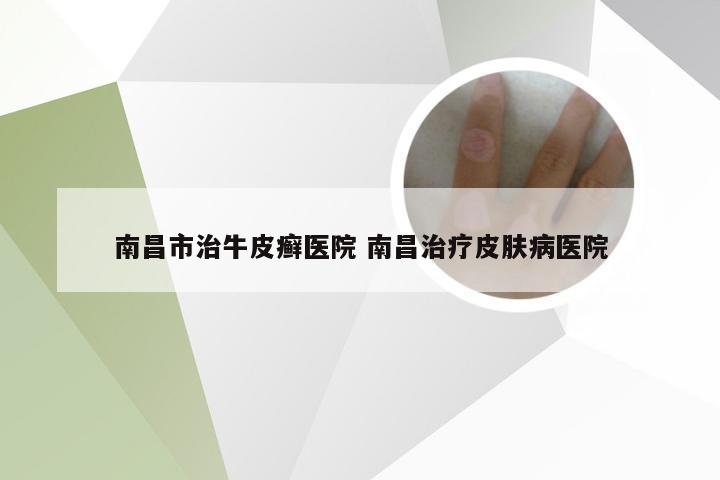 南昌市治牛皮癣医院 南昌治疗皮肤病医院