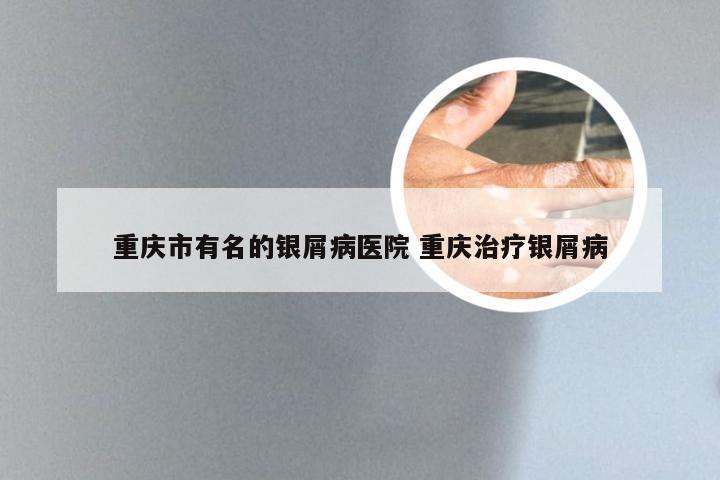 重庆市有名的银屑病医院 重庆治疗银屑病