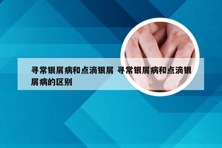 寻常银屑病和点滴银屑 寻常银屑病和点滴银屑病的区别