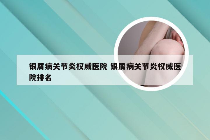 银屑病关节炎权威医院 银屑病关节炎权威医院排名