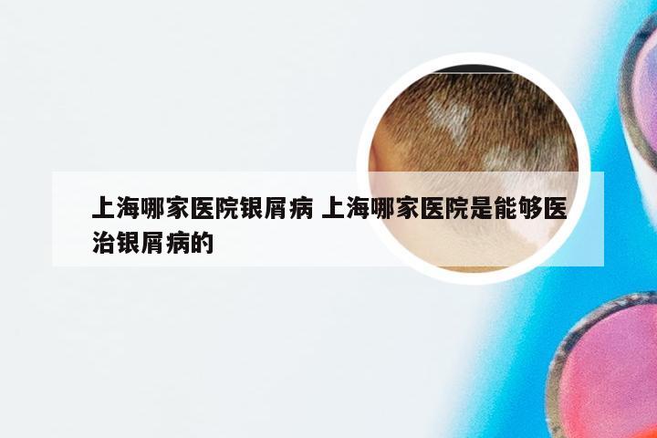 上海哪家医院银屑病 上海哪家医院是能够医治银屑病的