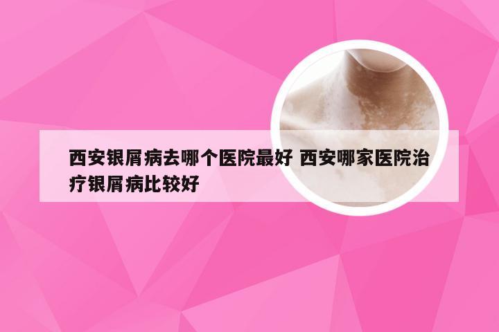 西安银屑病去哪个医院最好 西安哪家医院治疗银屑病比较好