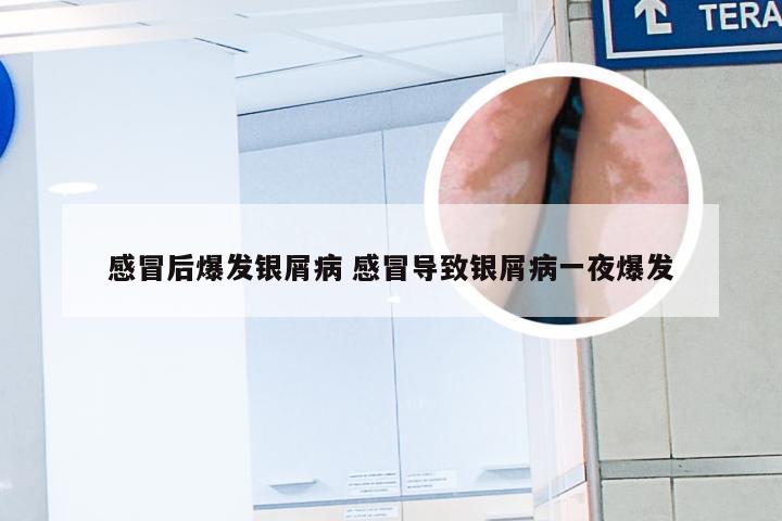 感冒后爆发银屑病 感冒导致银屑病一夜爆发