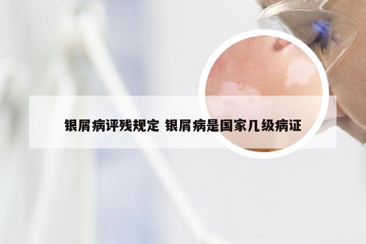 银屑病评残规定 银屑病是国家几级病证
