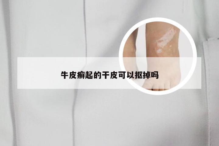 牛皮癣起的干皮可以抠掉吗