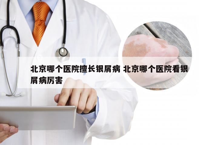 北京哪个医院擅长银屑病 北京哪个医院看银屑病厉害