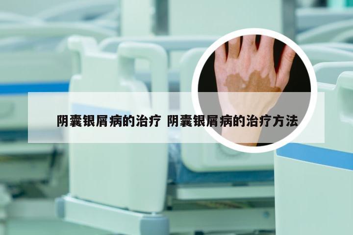 阴囊银屑病的治疗 阴囊银屑病的治疗方法