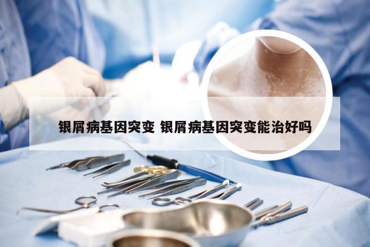银屑病基因突变 银屑病基因突变能治好吗