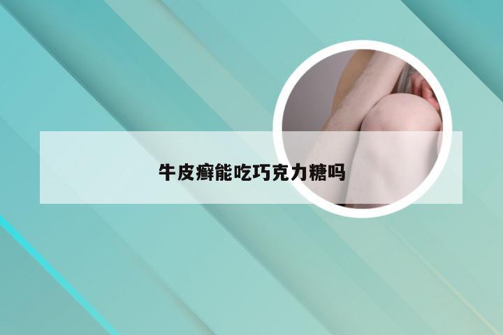 牛皮癣能吃巧克力糖吗