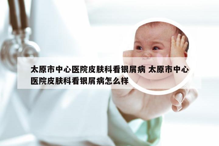 太原市中心医院皮肤科看银屑病 太原市中心医院皮肤科看银屑病怎么样