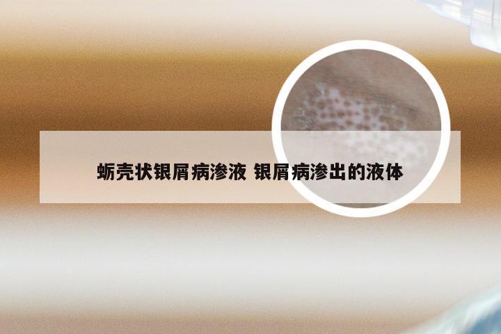 蛎壳状银屑病渗液 银屑病渗出的液体