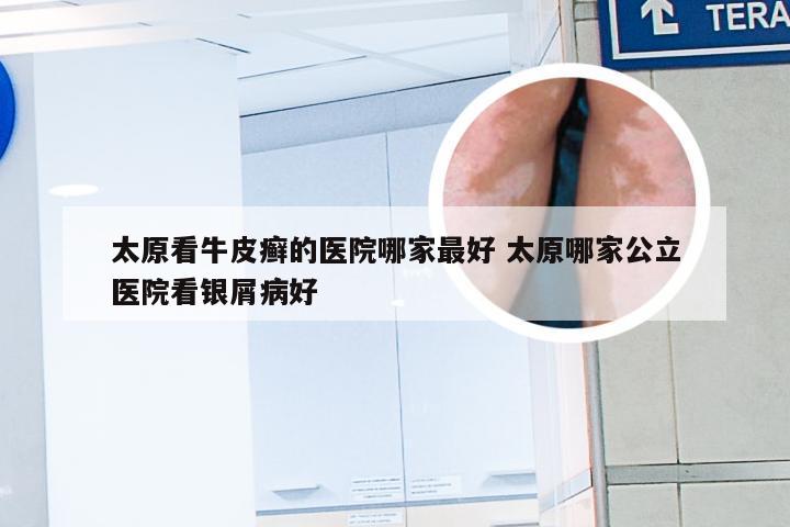 太原看牛皮癣的医院哪家最好 太原哪家公立医院看银屑病好