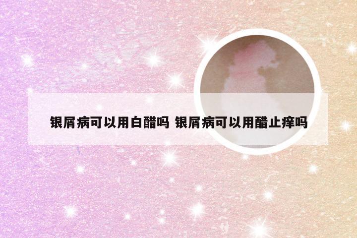 银屑病可以用白醋吗 银屑病可以用醋止痒吗