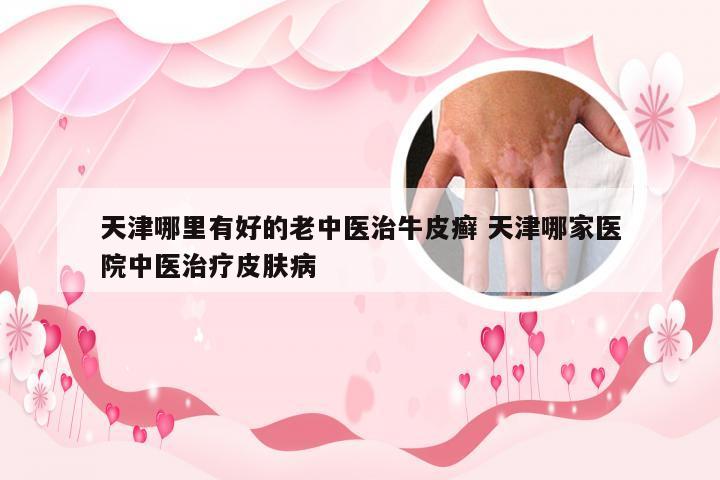 天津哪里有好的老中医治牛皮癣 天津哪家医院中医治疗皮肤病