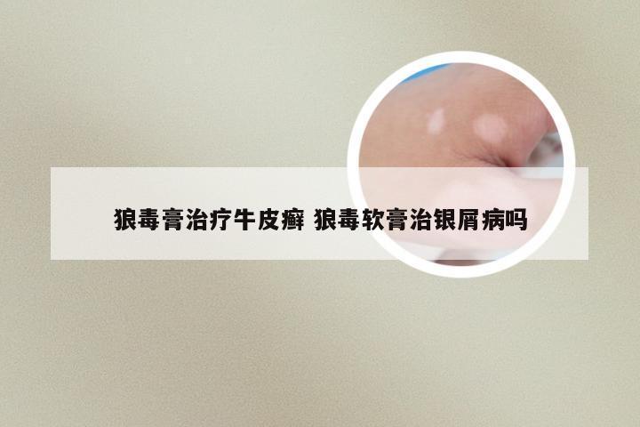狼毒膏治疗牛皮癣 狼毒软膏治银屑病吗