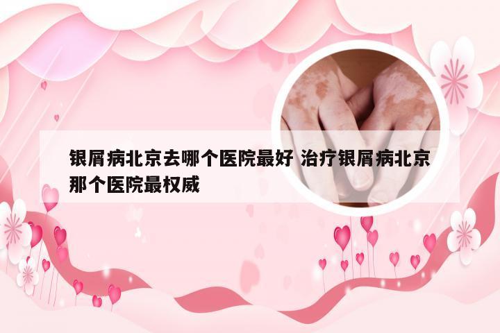 银屑病北京去哪个医院最好 治疗银屑病北京那个医院最权威