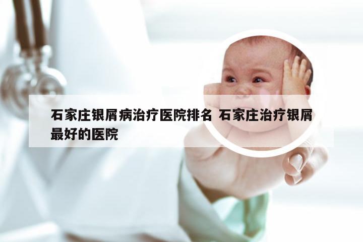 石家庄银屑病治疗医院排名 石家庄治疗银屑最好的医院