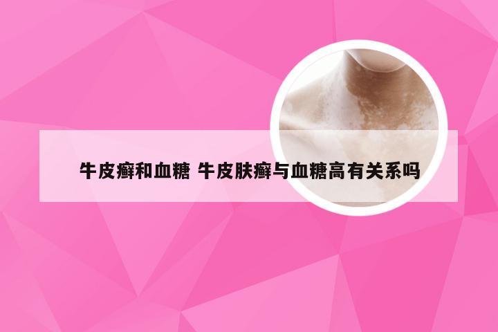 牛皮癣和血糖 牛皮肤癣与血糖高有关系吗