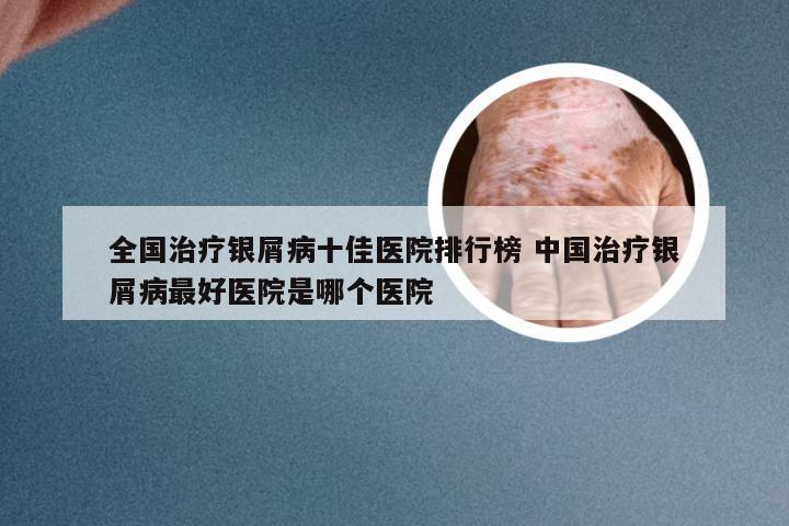 全国治疗银屑病十佳医院排行榜 中国治疗银屑病最好医院是哪个医院