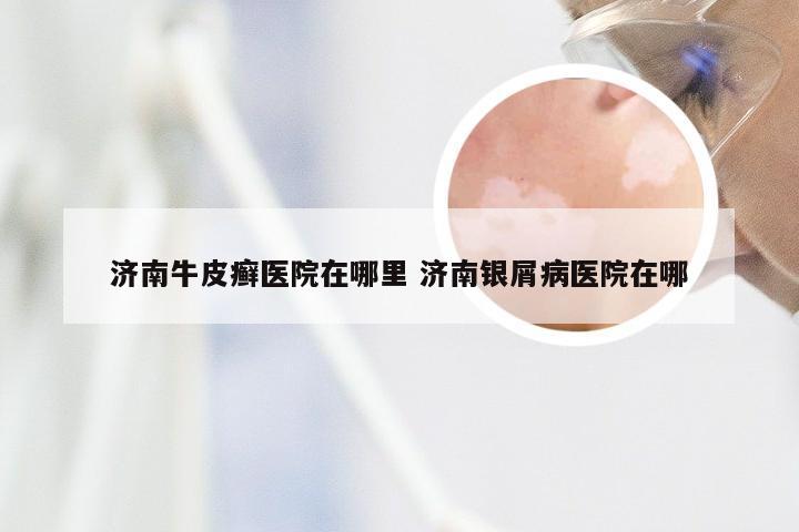 济南牛皮癣医院在哪里 济南银屑病医院在哪
