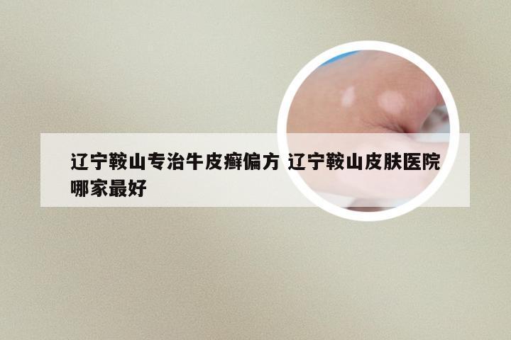 辽宁鞍山专治牛皮癣偏方 辽宁鞍山皮肤医院哪家最好