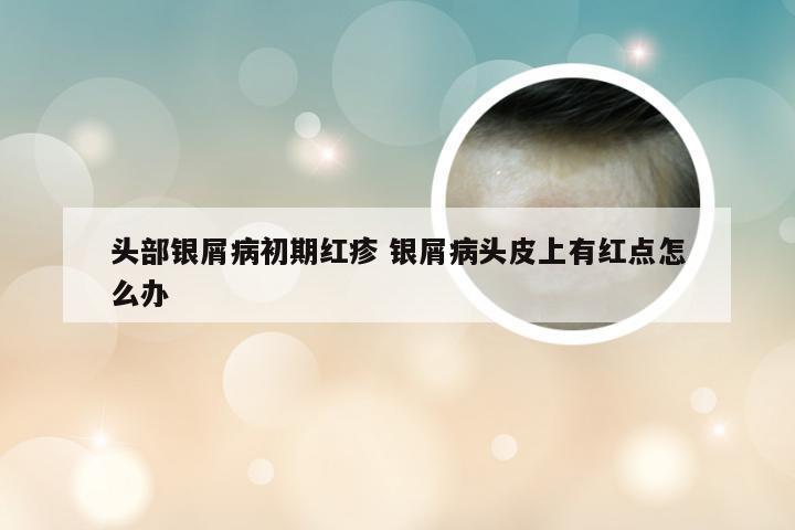 头部银屑病初期红疹 银屑病头皮上有红点怎么办