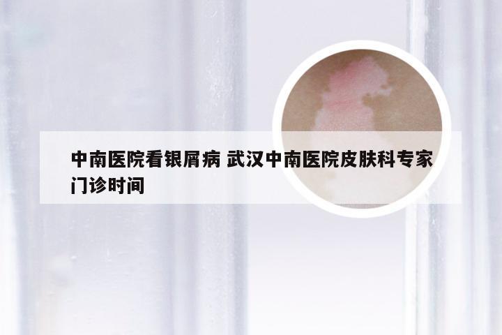 中南医院看银屑病 武汉中南医院皮肤科专家门诊时间