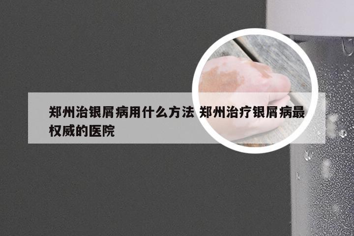 郑州治银屑病用什么方法 郑州治疗银屑病最权威的医院