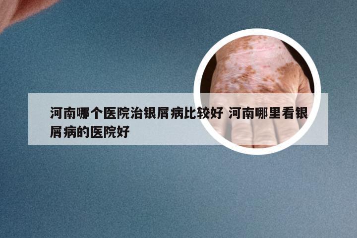 河南哪个医院治银屑病比较好 河南哪里看银屑病的医院好