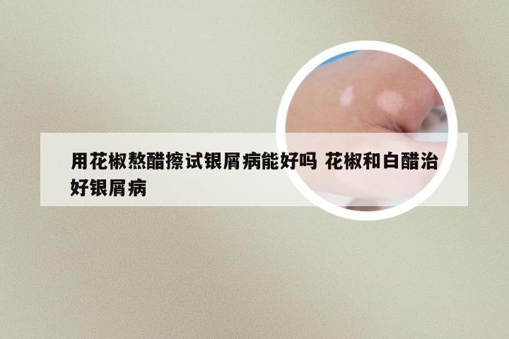 用花椒熬醋擦试银屑病能好吗 花椒和白醋治好银屑病