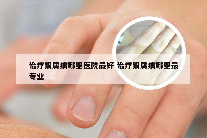 治疗银屑病哪里医院最好 治疗银屑病哪里最专业