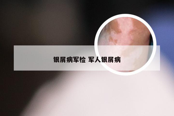 银屑病军检 军人银屑病