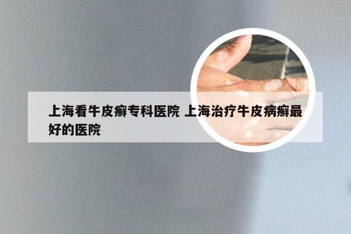 上海看牛皮癣专科医院 上海治疗牛皮病癣最好的医院