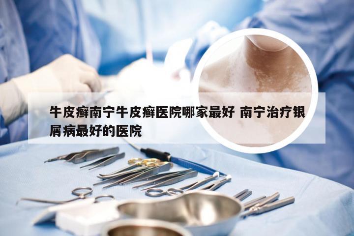 牛皮癣南宁牛皮癣医院哪家最好 南宁治疗银屑病最好的医院
