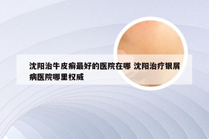 沈阳治牛皮癣最好的医院在哪 沈阳治疗银屑病医院哪里权威