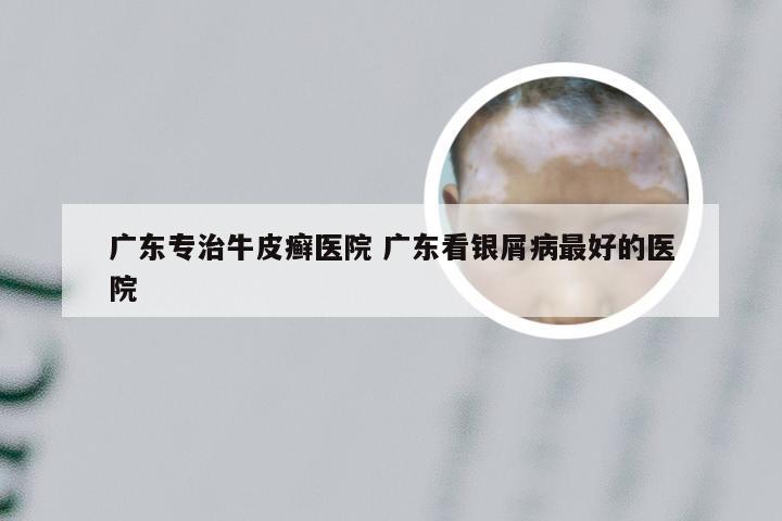 广东专治牛皮癣医院 广东看银屑病最好的医院