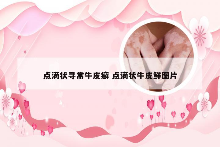 点滴状寻常牛皮癣 点滴状牛皮鲜图片