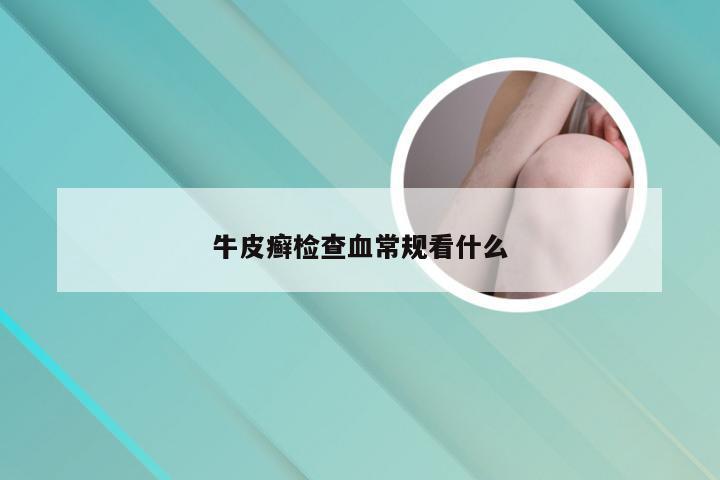 牛皮癣检查血常规看什么