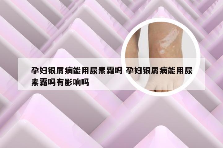 孕妇银屑病能用尿素霜吗 孕妇银屑病能用尿素霜吗有影响吗