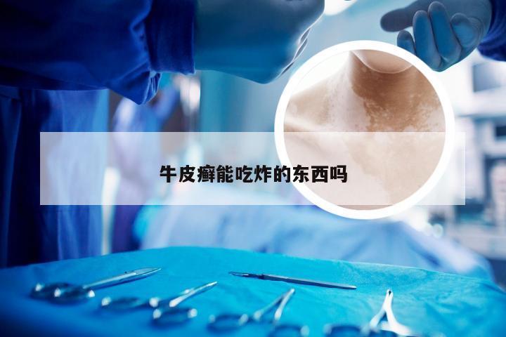 牛皮癣能吃炸的东西吗