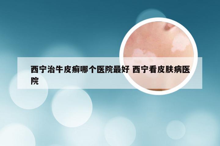 西宁治牛皮癣哪个医院最好 西宁看皮肤病医院