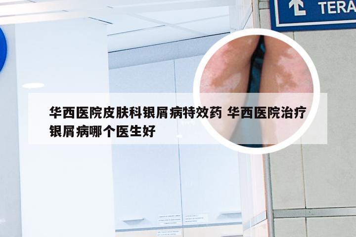 华西医院皮肤科银屑病特效药 华西医院治疗银屑病哪个医生好