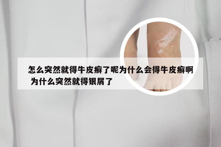 怎么突然就得牛皮癣了呢为什么会得牛皮癣啊 为什么突然就得银屑了