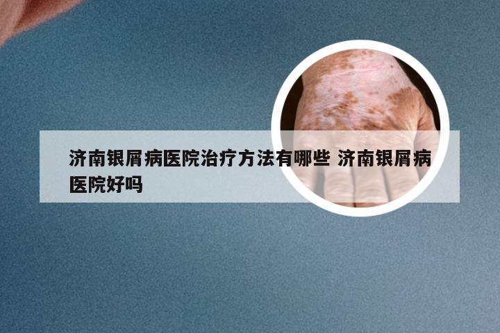 济南银屑病医院治疗方法有哪些 济南银屑病医院好吗