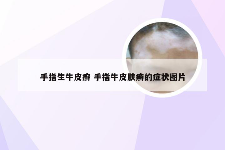 手指生牛皮癣 手指牛皮肤癣的症状图片