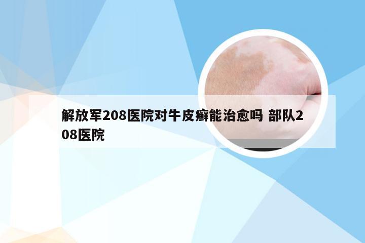 解放军208医院对牛皮癣能治愈吗 部队208医院